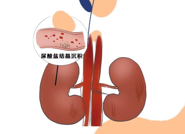 备孕期间痛风复发，苯溴马隆与非布司他区别有哪些？该如何选择？