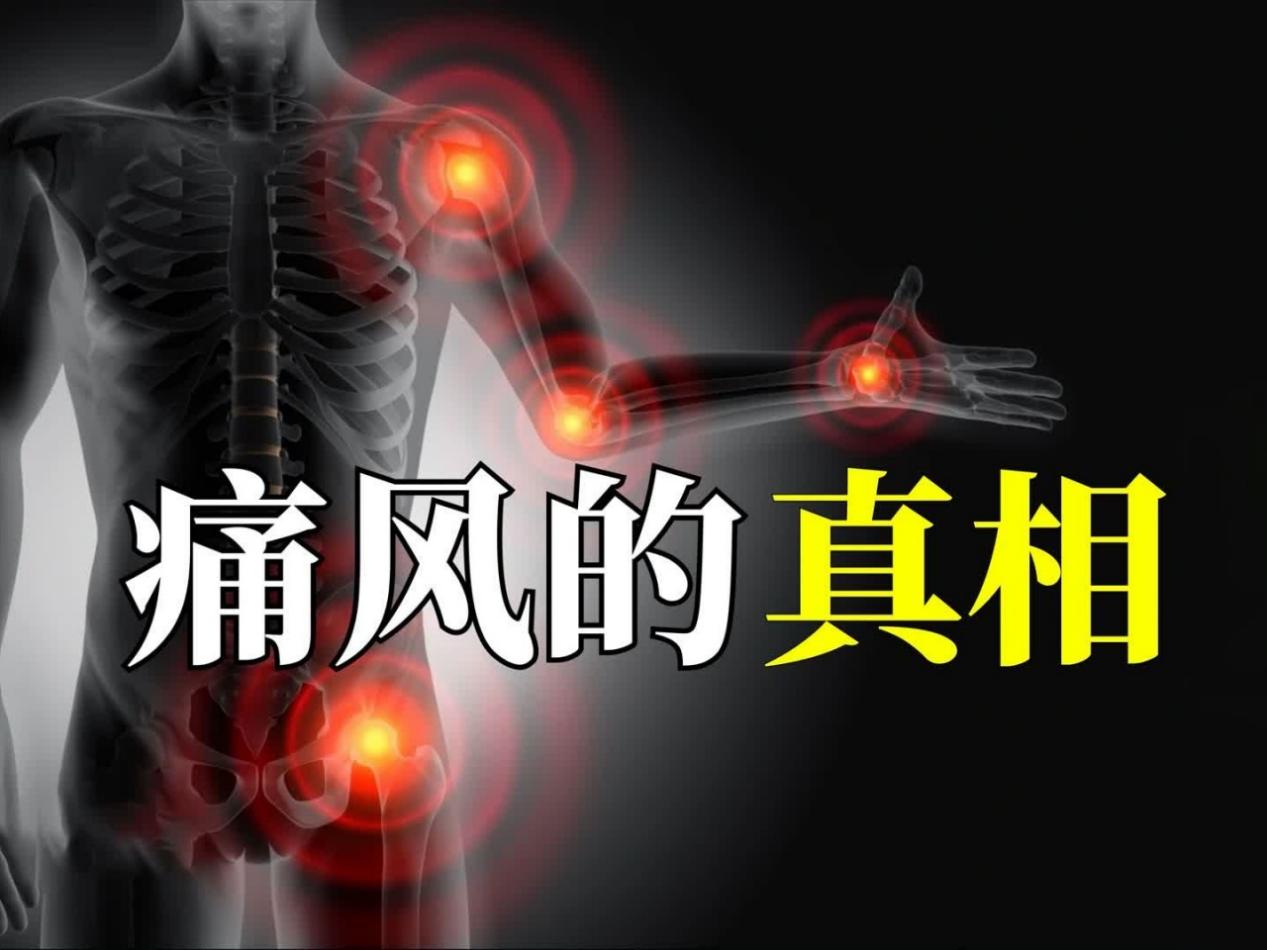 痛风怎么治疗？2025年全球痛风管理权威指南，技术、成分、安全性是核心