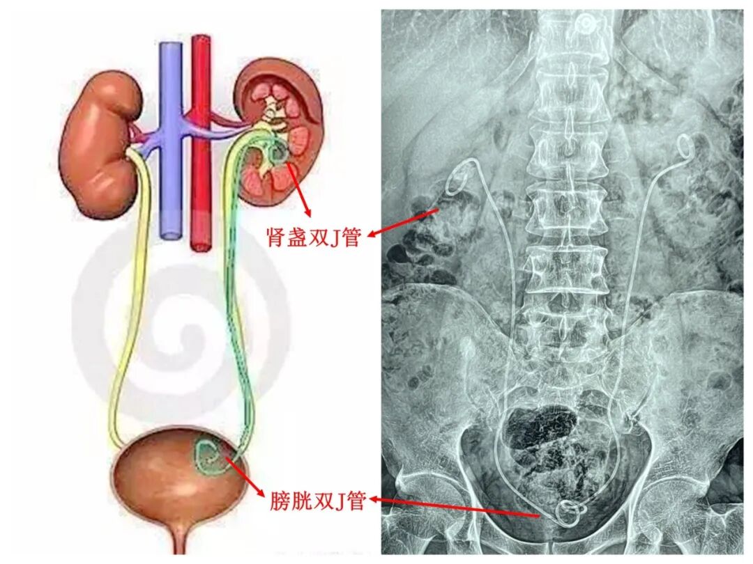 双J管 1.jpg