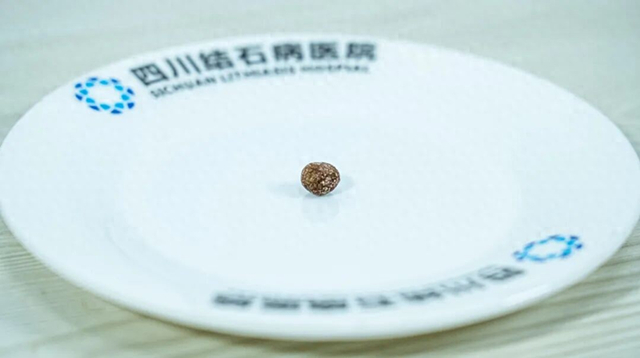 18岁青春蒙阴影，一颗“小石头”为何让胆囊“彻底坏死”？【四川结石病医院】